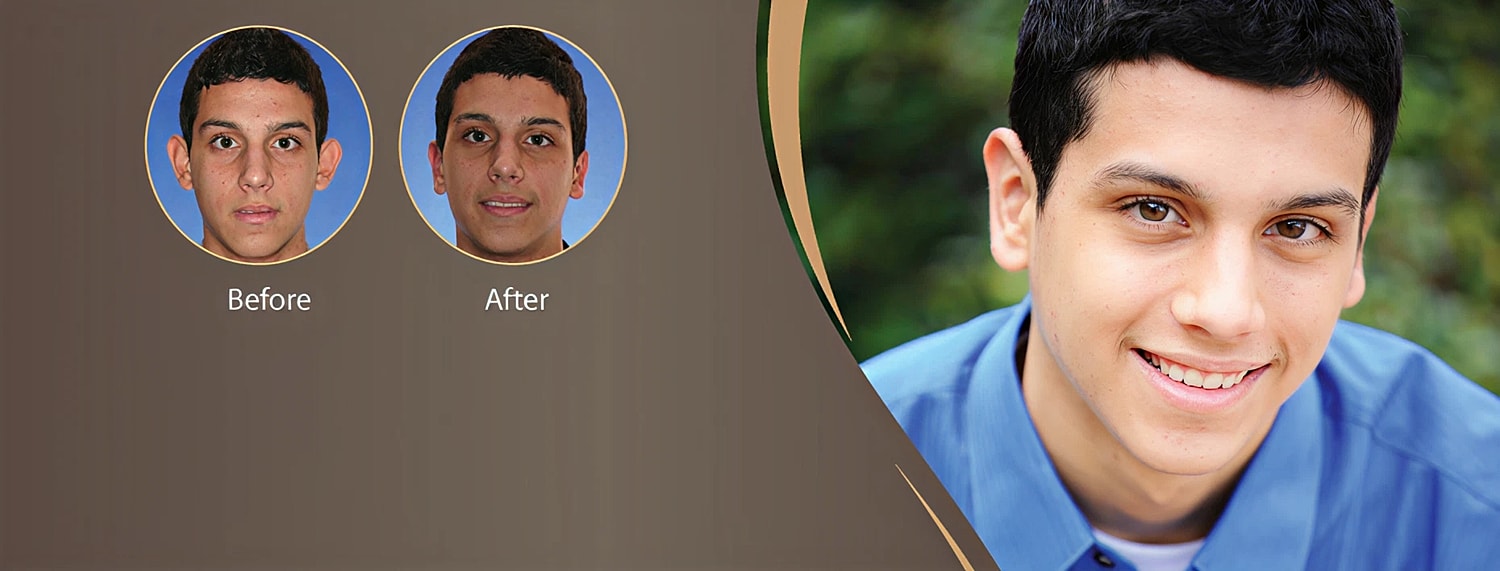 Otoplasty for men 