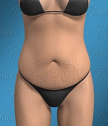 Model in bikini displaying stretch marks.