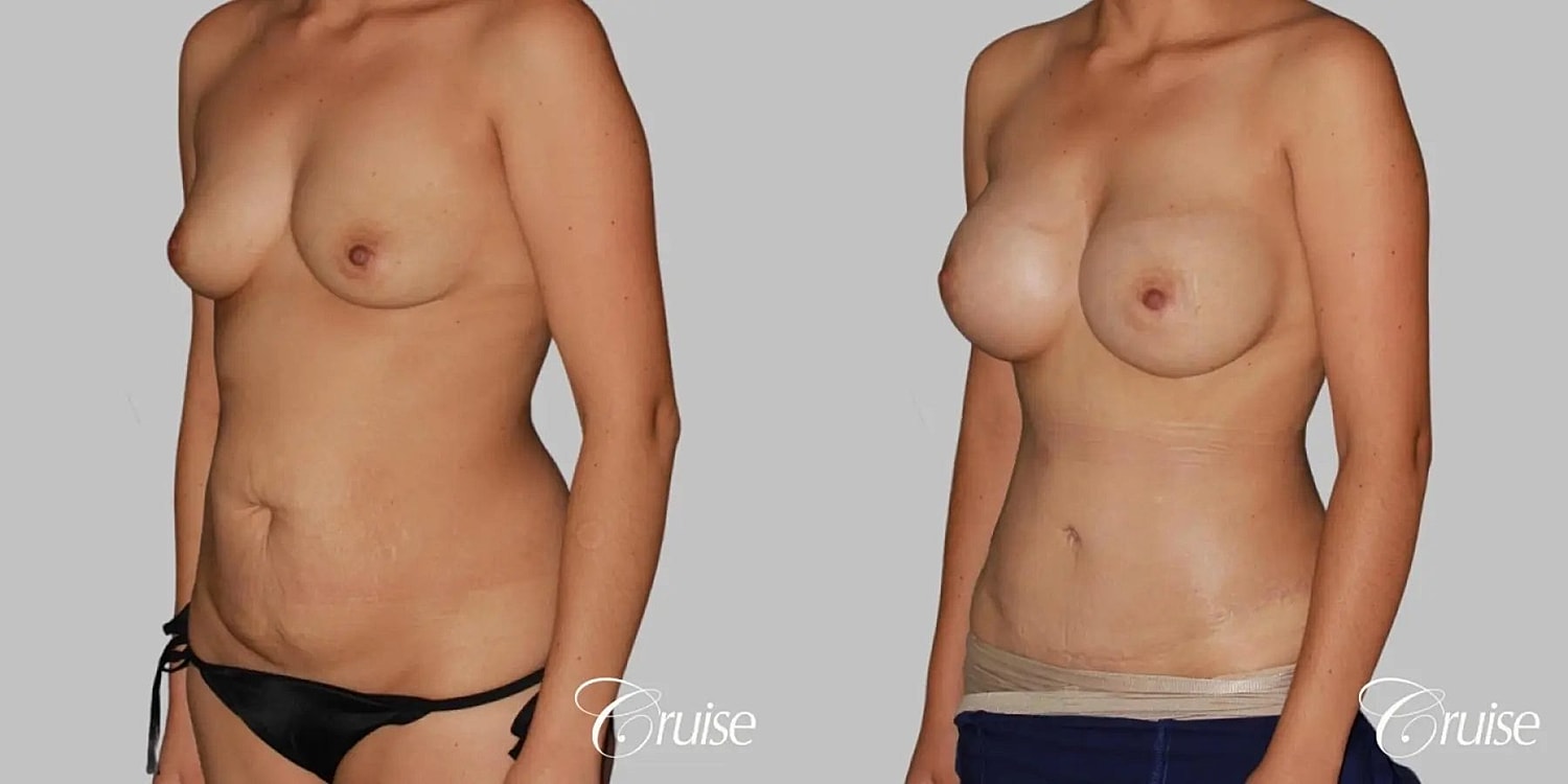 Tummy Tuck Before & After
