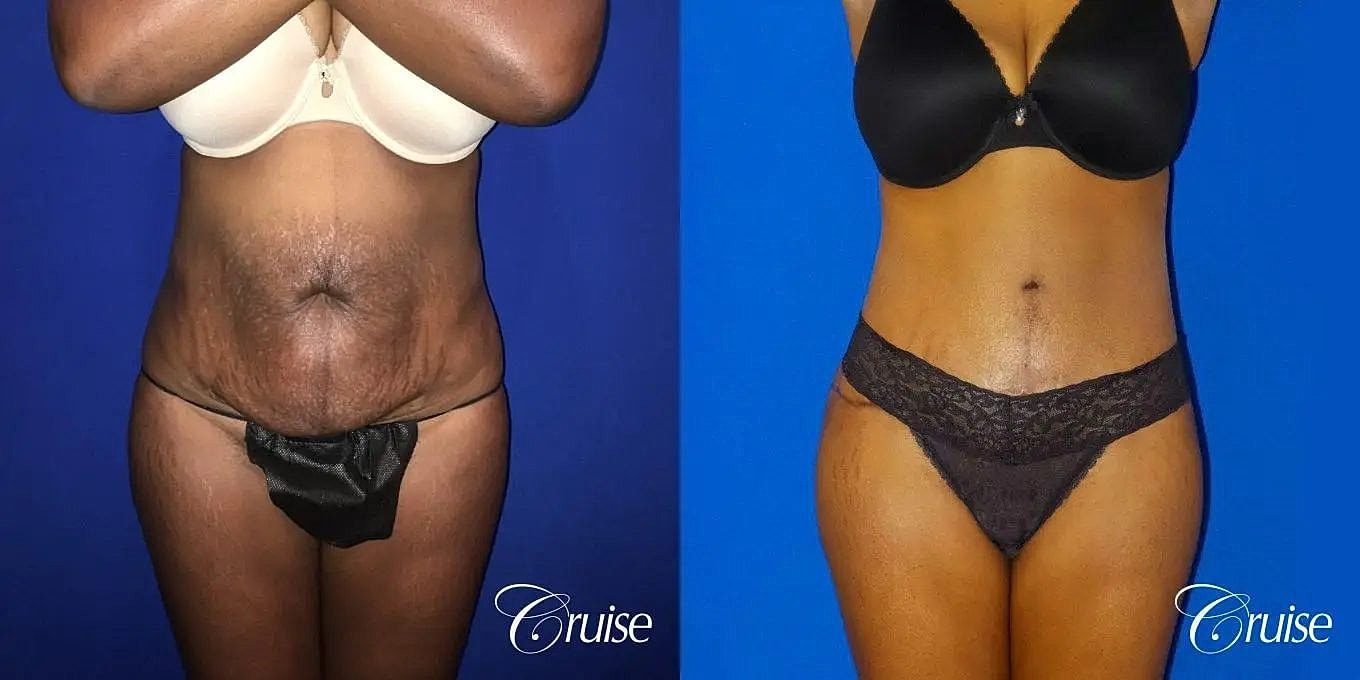 Tummy Tuck Before & After