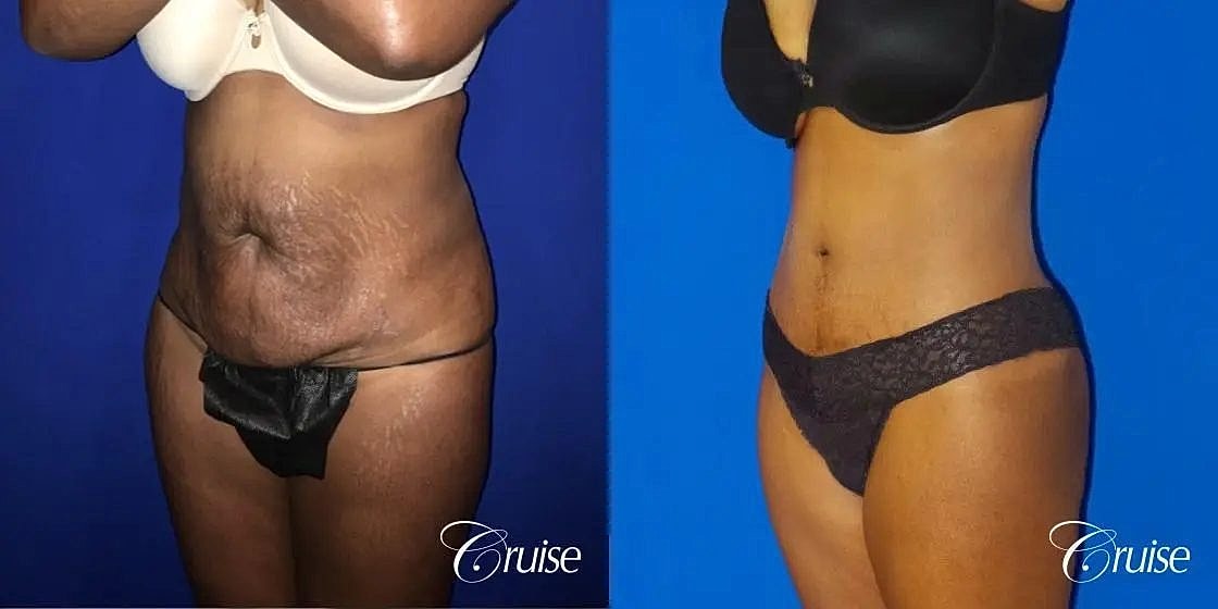 Tummy Tuck Before & After