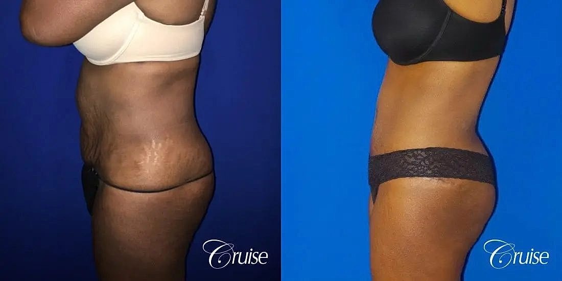 Tummy Tuck Before & After