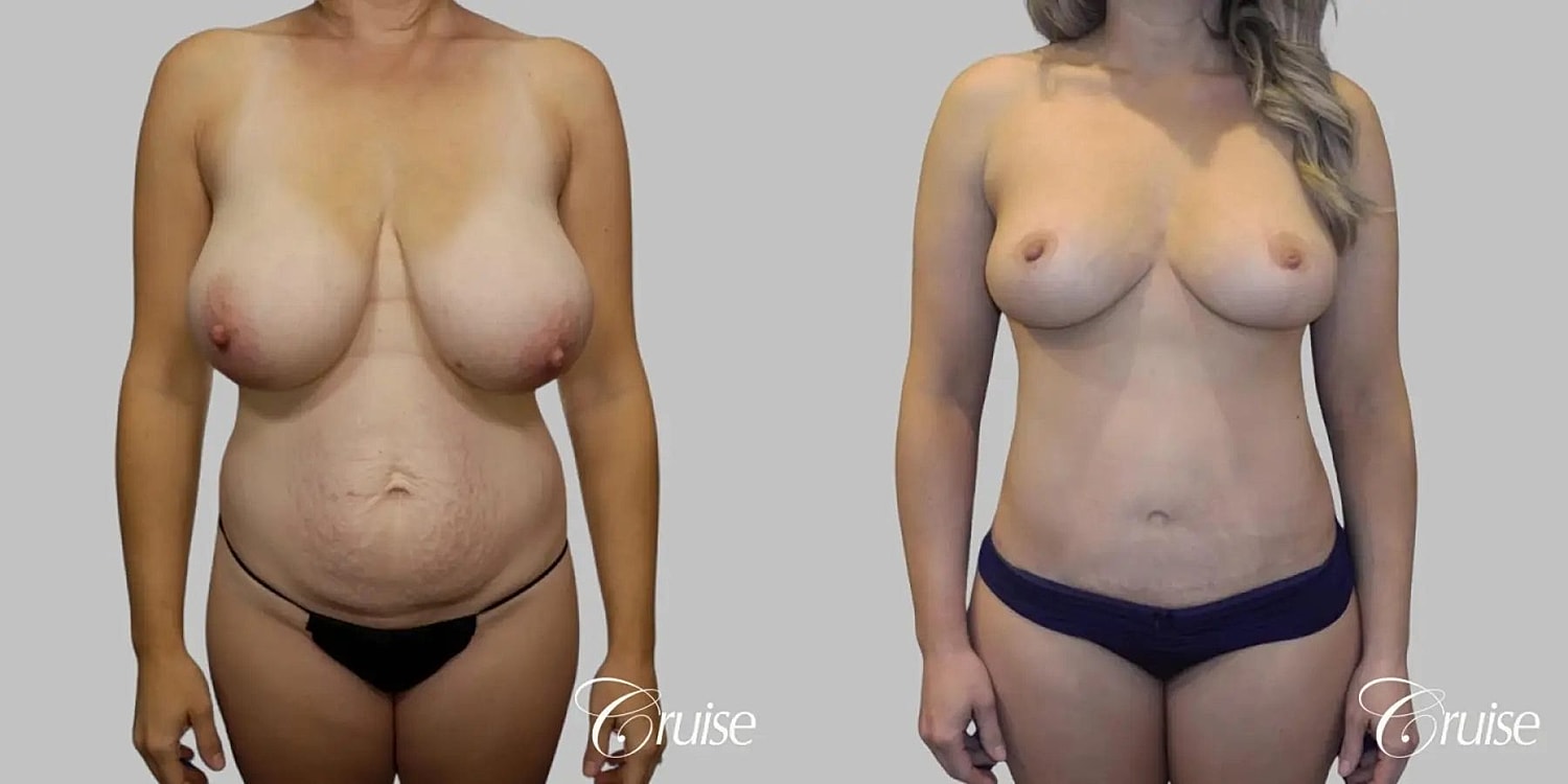 Tummy Tuck Before & After