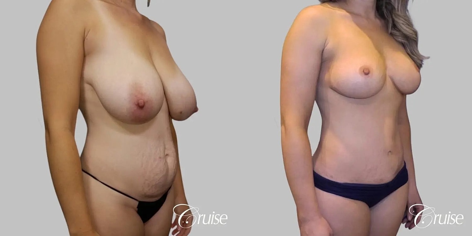 Tummy Tuck Before & After