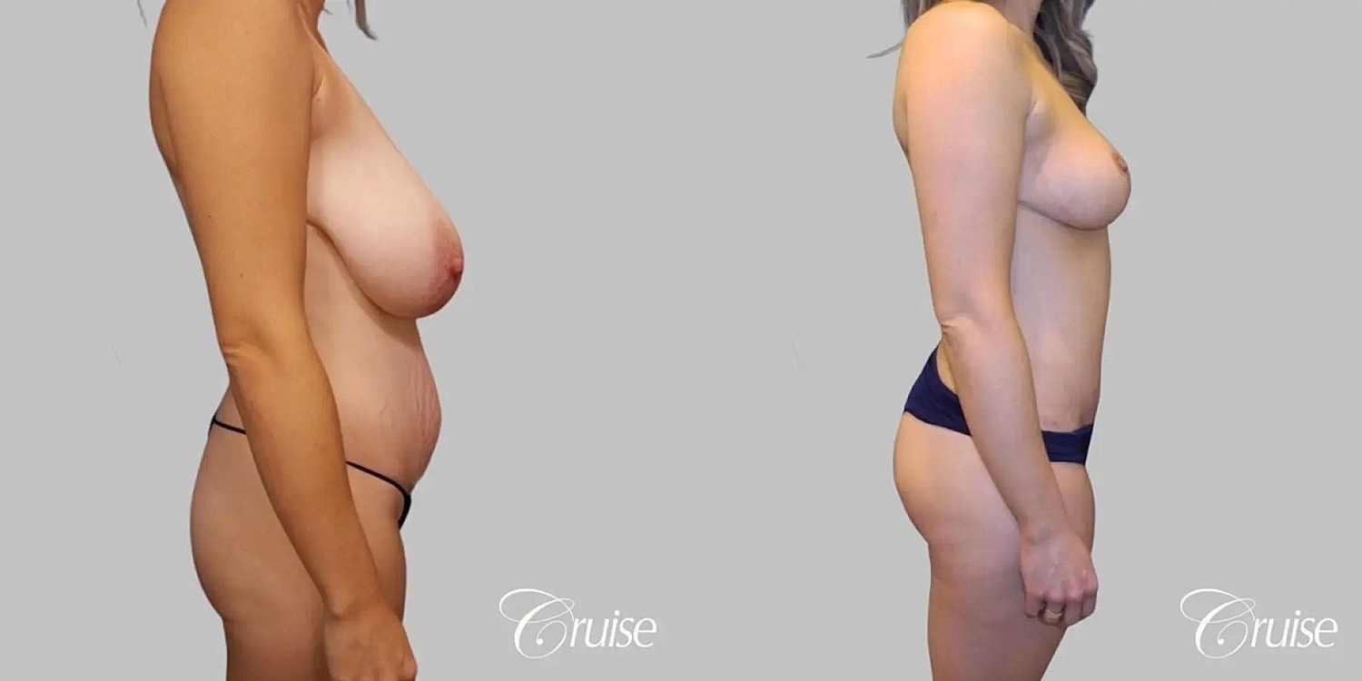 Tummy Tuck Before & After