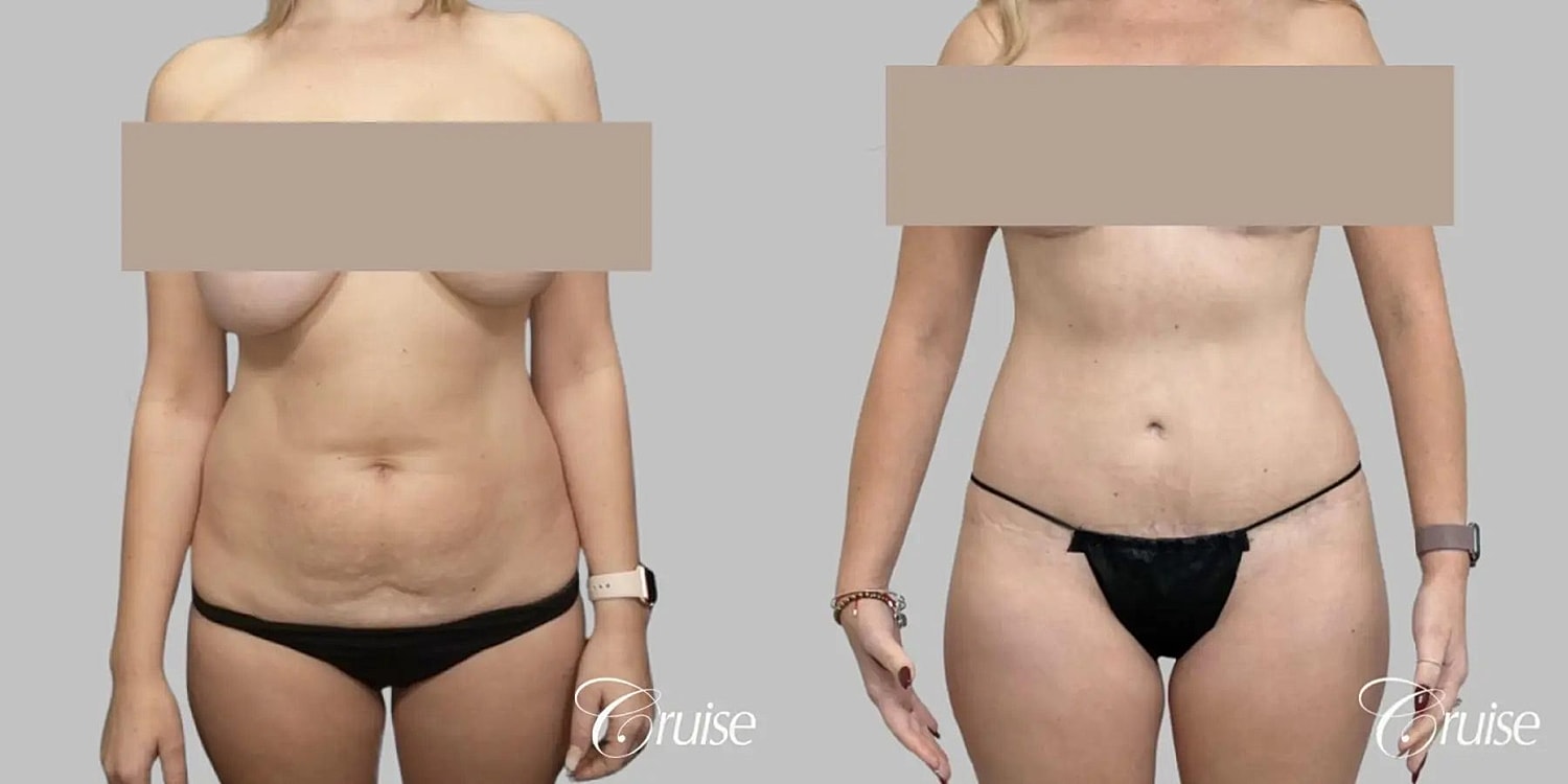 Tummy Tuck Before & After