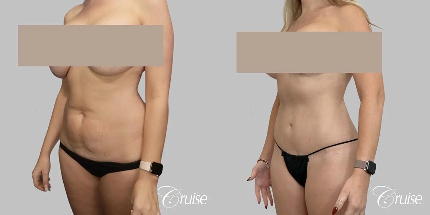 Tummy Tuck Before & After