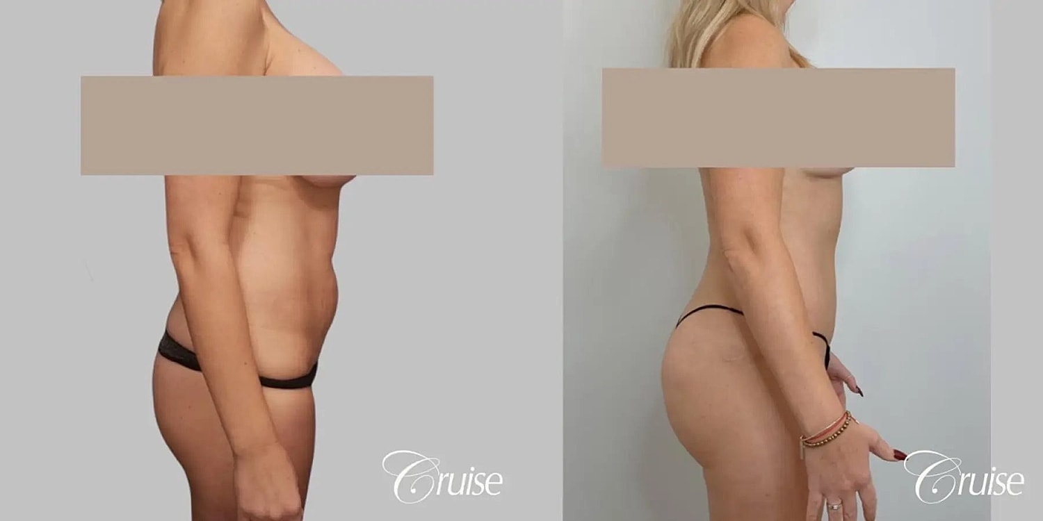 Tummy Tuck Before & After