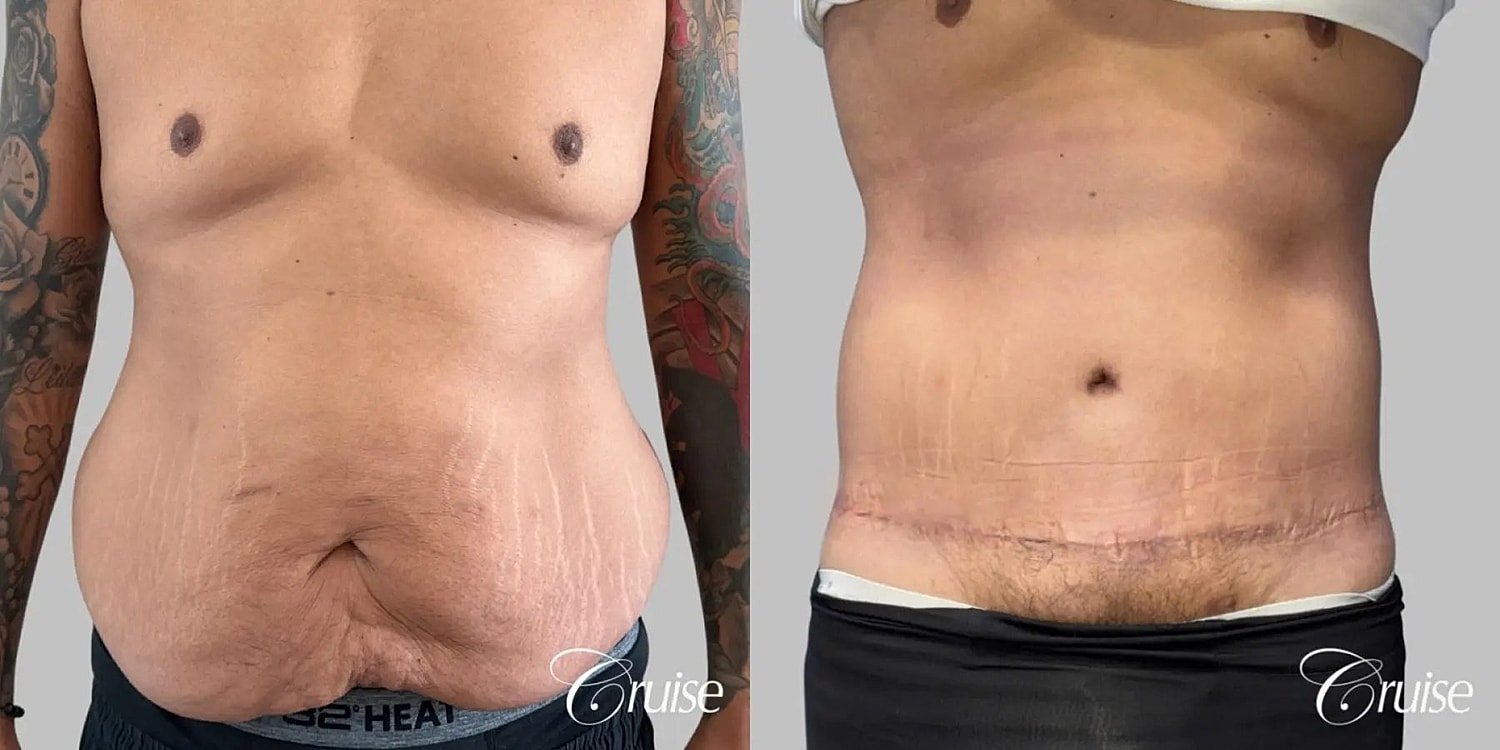 Tummy Tuck Before & After