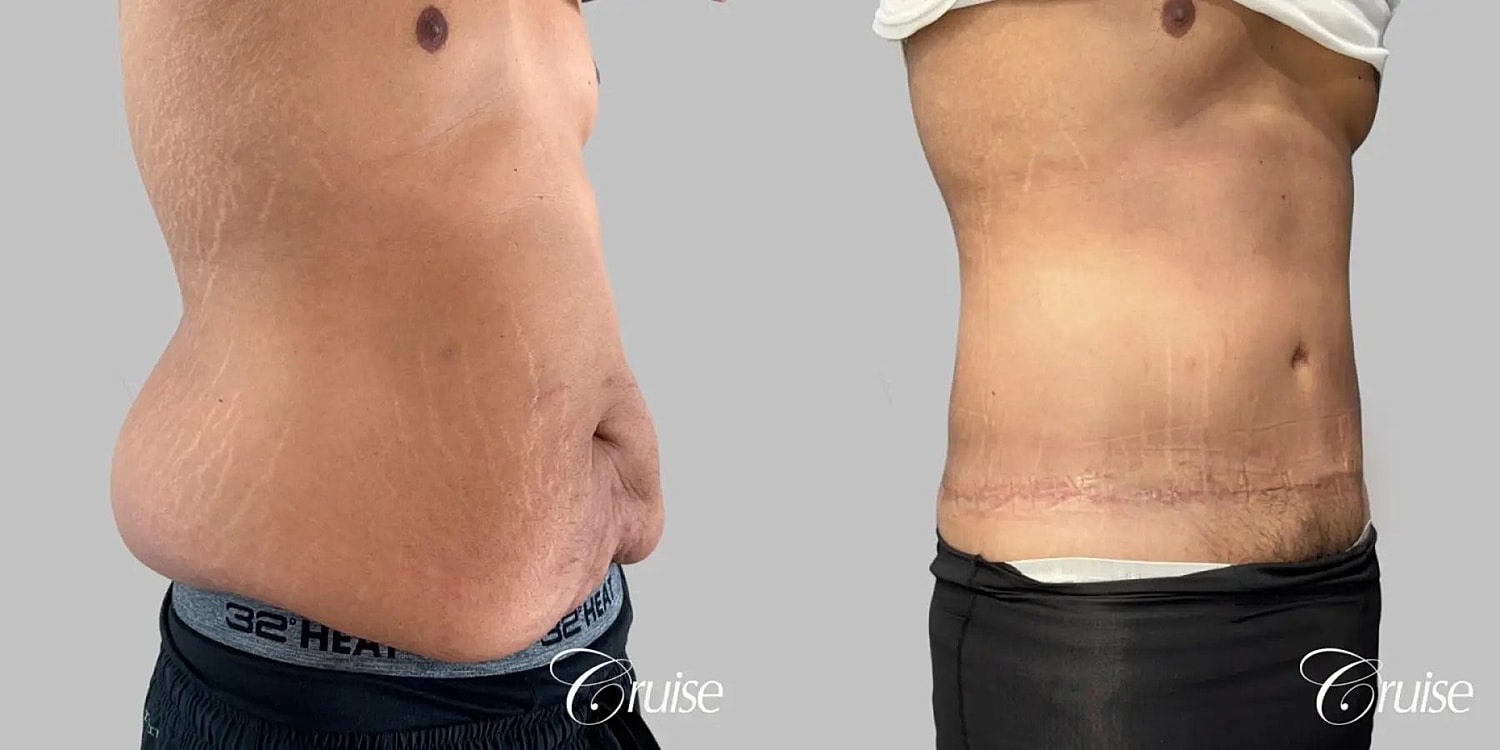 Tummy Tuck Before & After