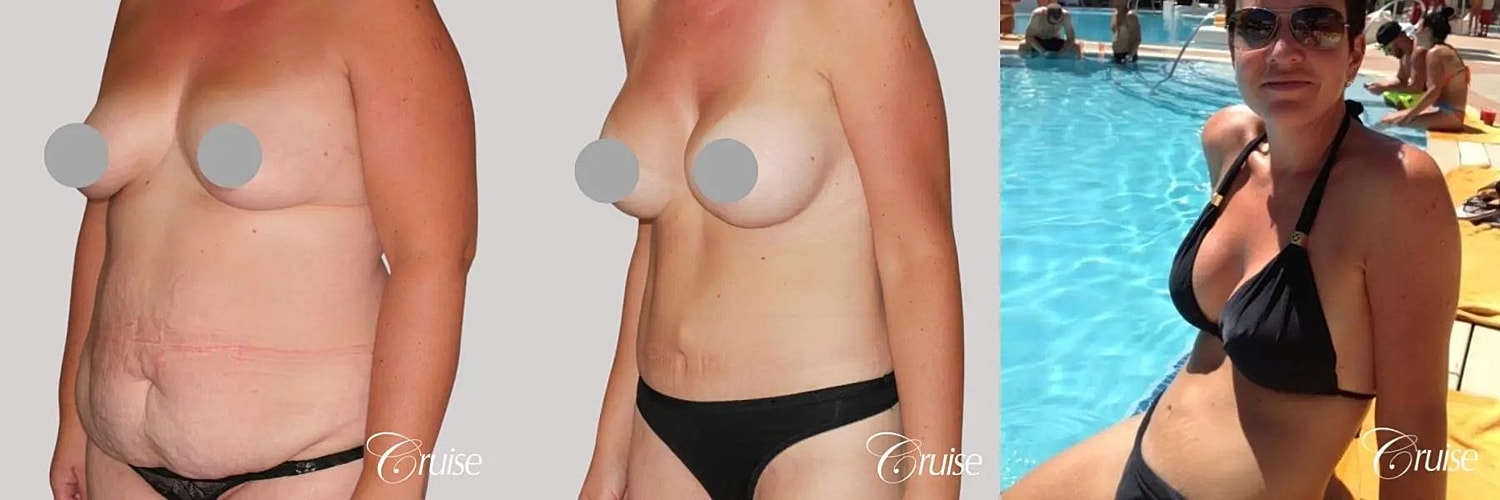 Tummy Tuck Before & After