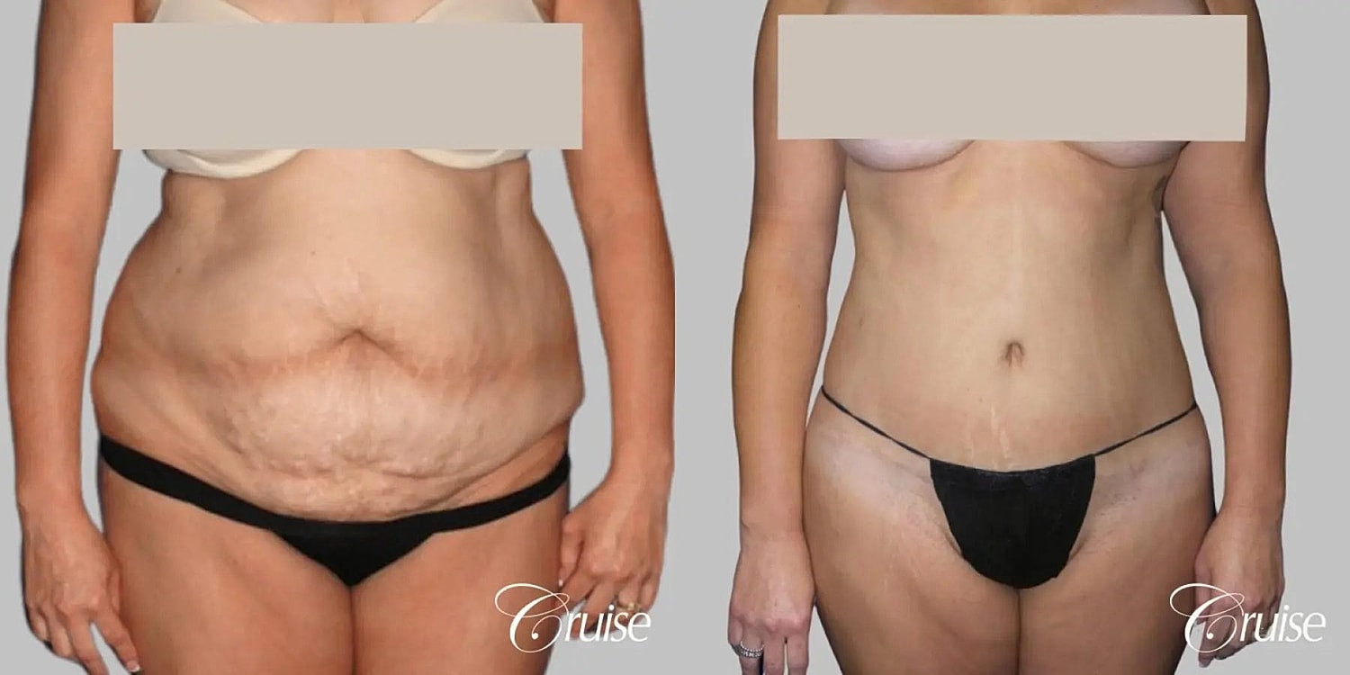 Tummy Tuck Before & After