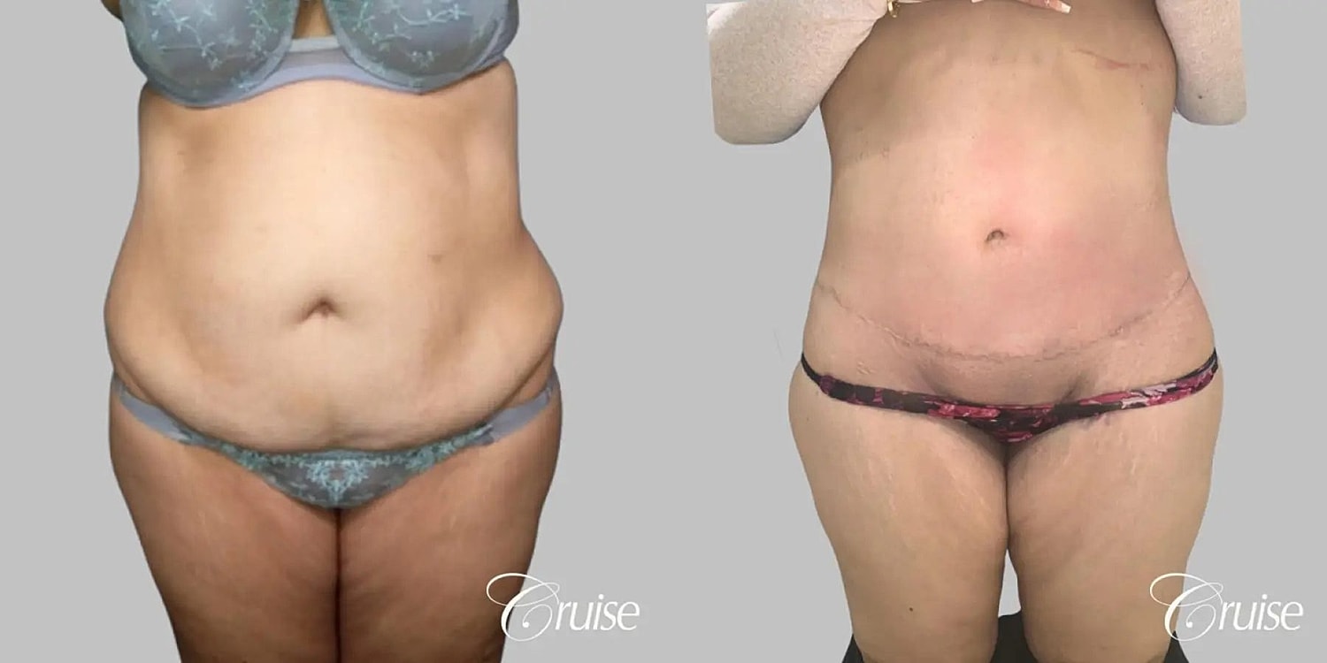 Tummy Tuck Before & After