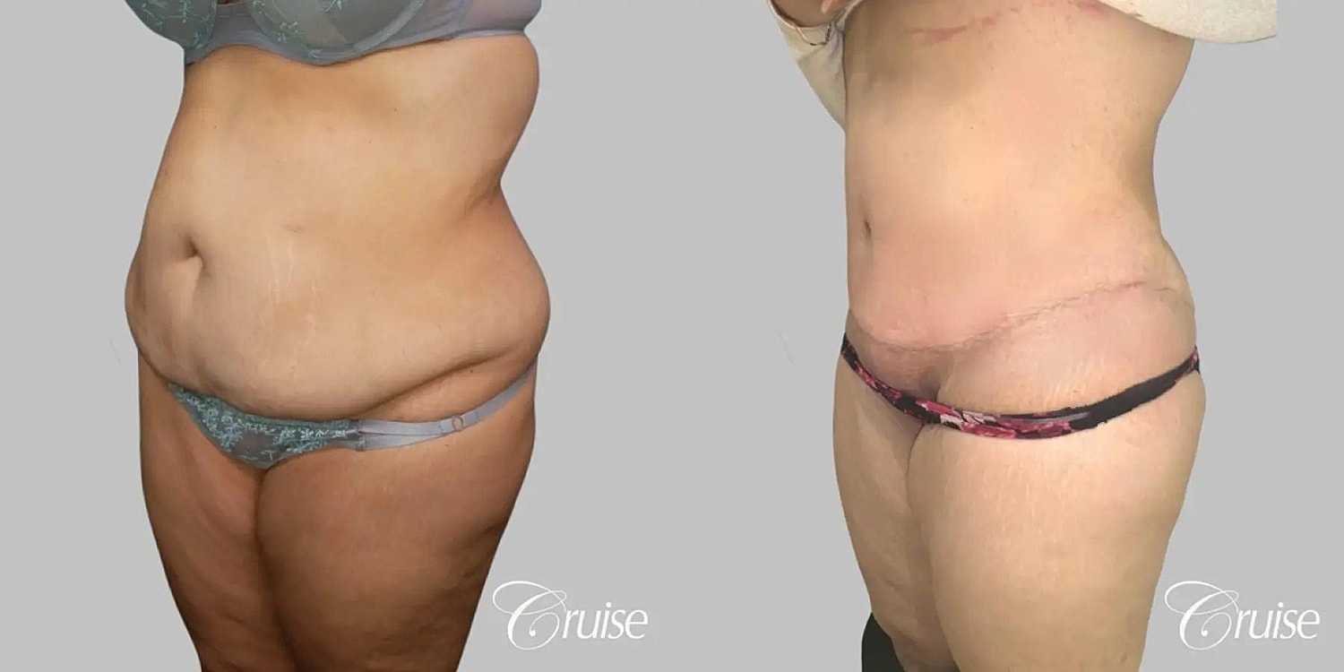 Tummy Tuck Before & After