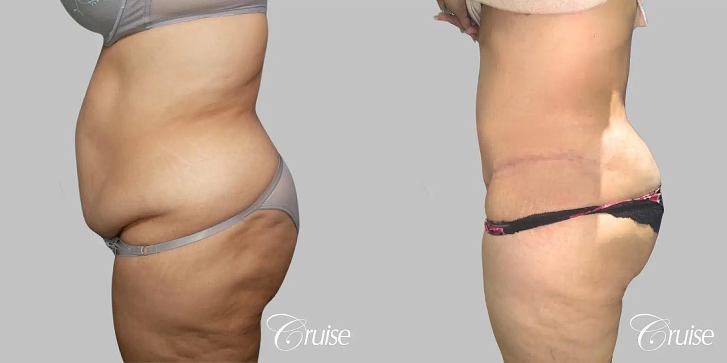 Tummy Tuck Before & After