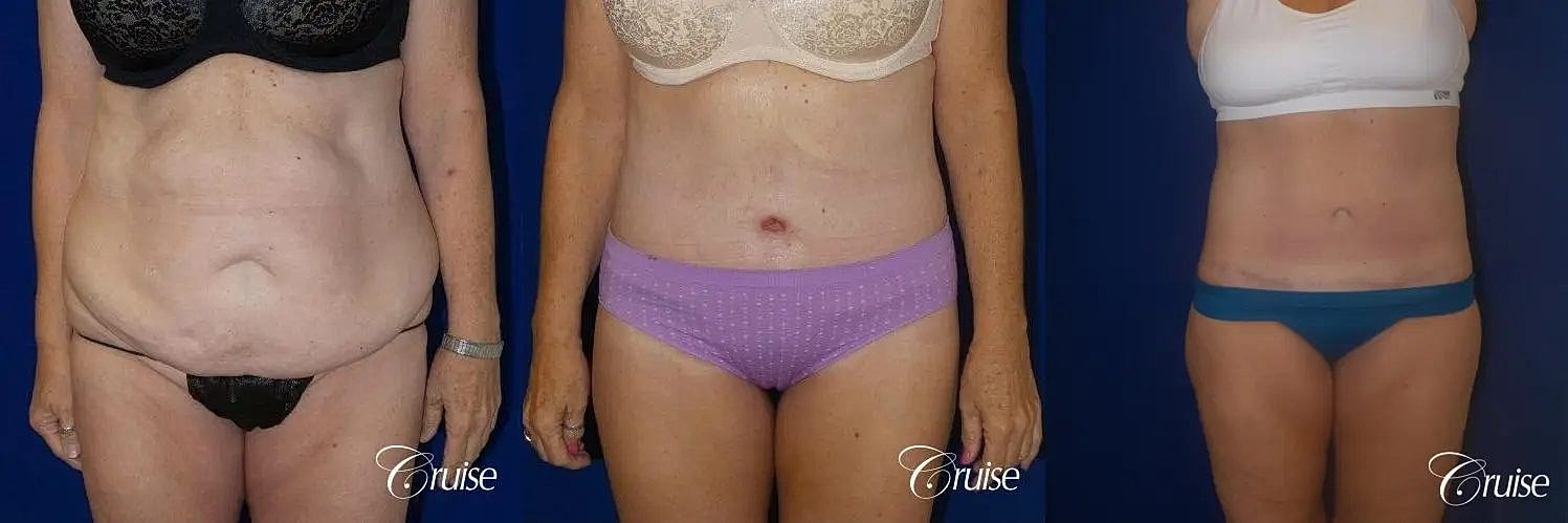 Tummy Tuck Before & After