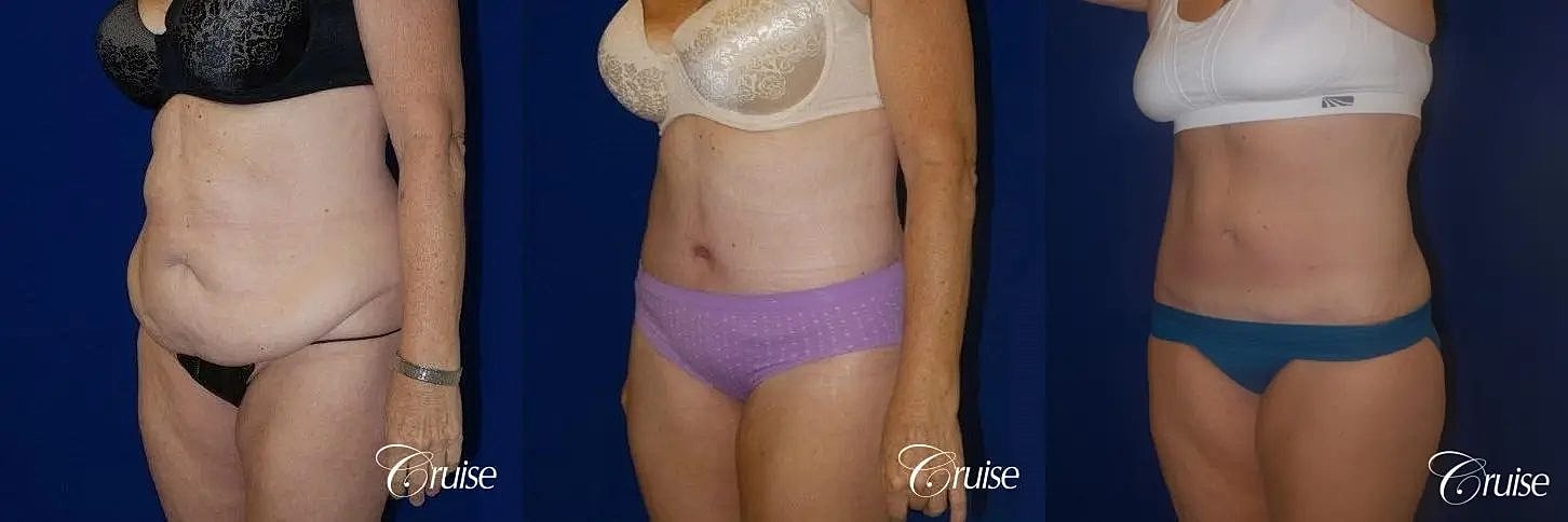 Tummy Tuck Before & After