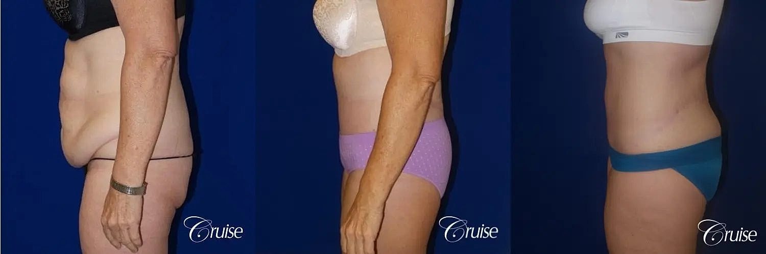 Tummy Tuck Before & After