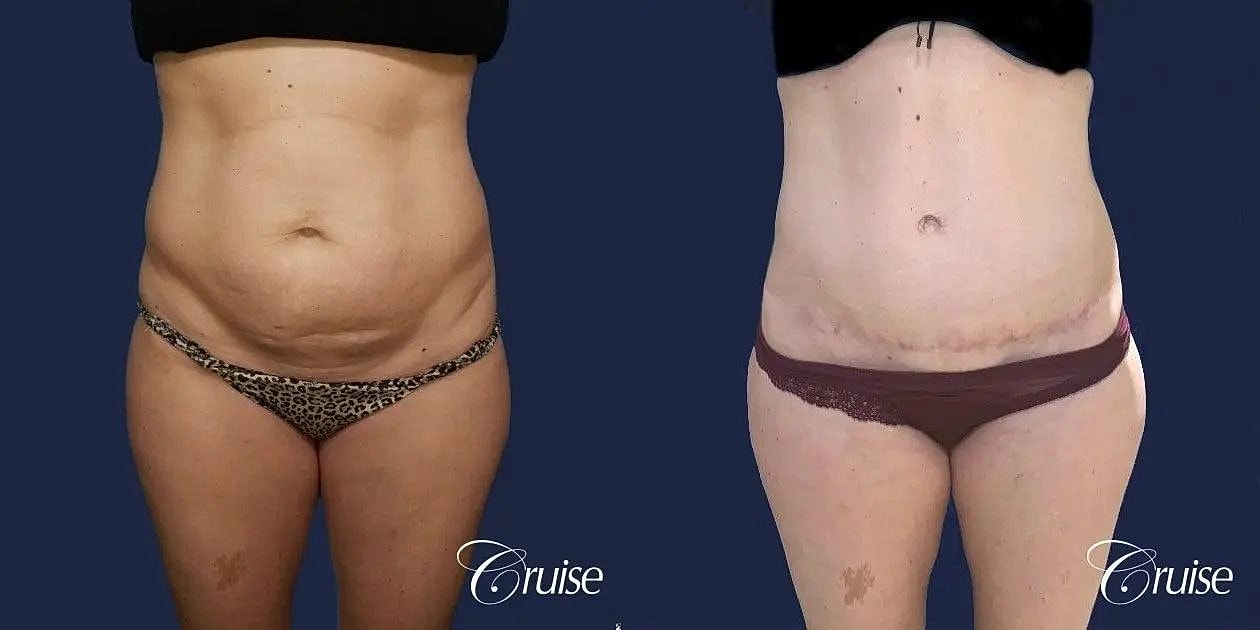 Tummy Tuck Before & After