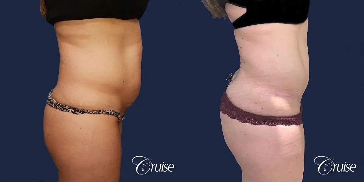 Tummy Tuck Before & After