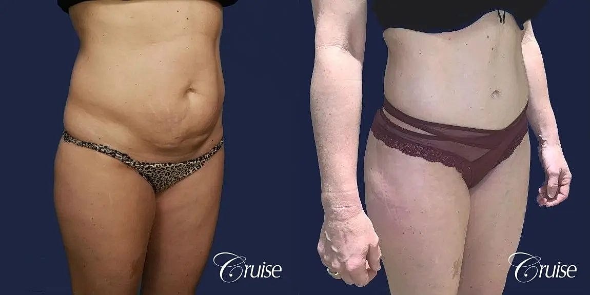 Tummy Tuck Before & After