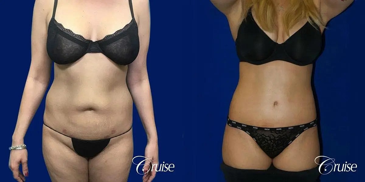 Tummy Tuck Before & After