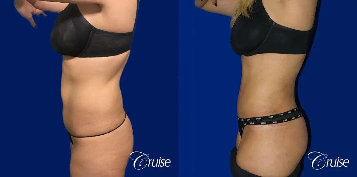 Tummy Tuck Before & After