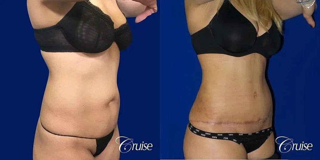 Tummy Tuck Before & After