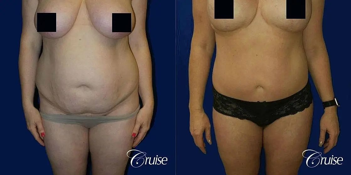 Tummy Tuck Before & After