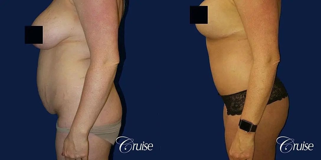 Tummy Tuck Before & After