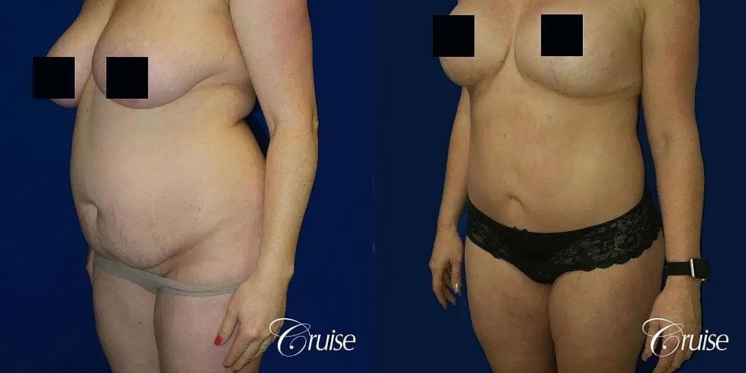 Tummy Tuck Before & After