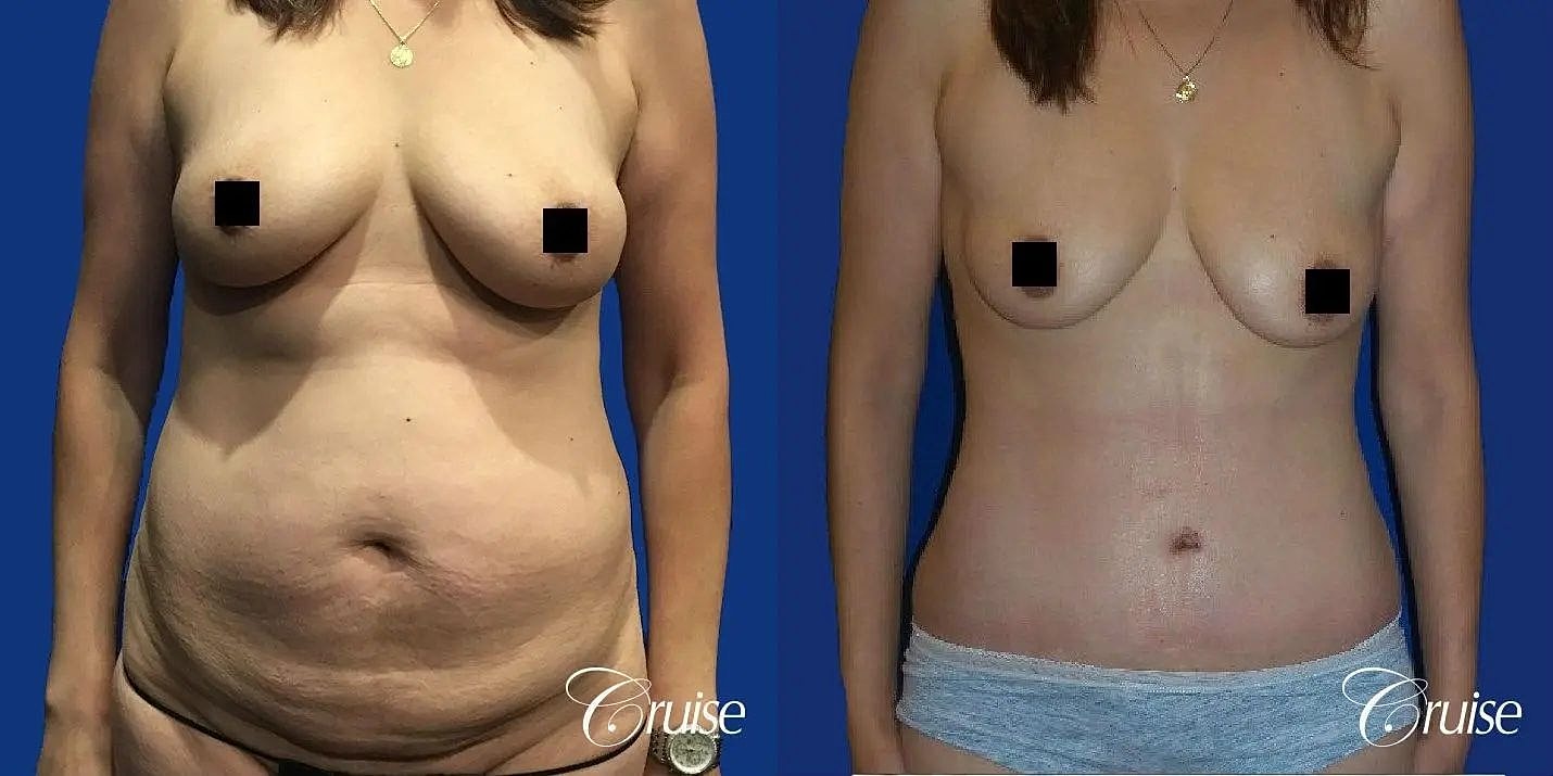 Tummy Tuck Before & After