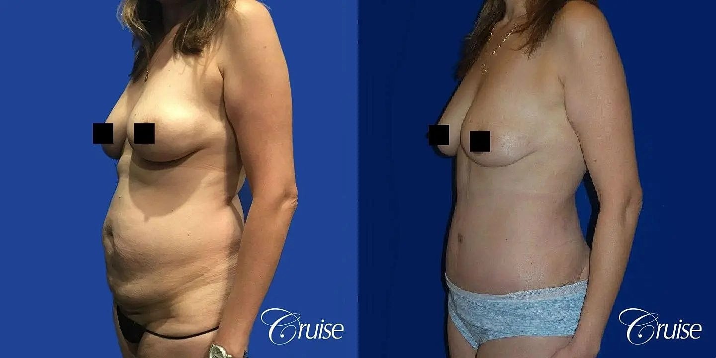 Tummy Tuck Before & After