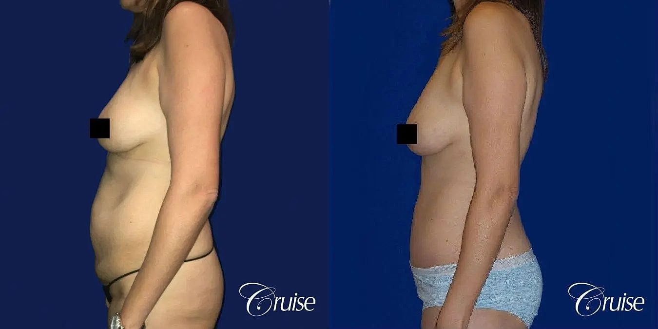 Tummy Tuck Before & After