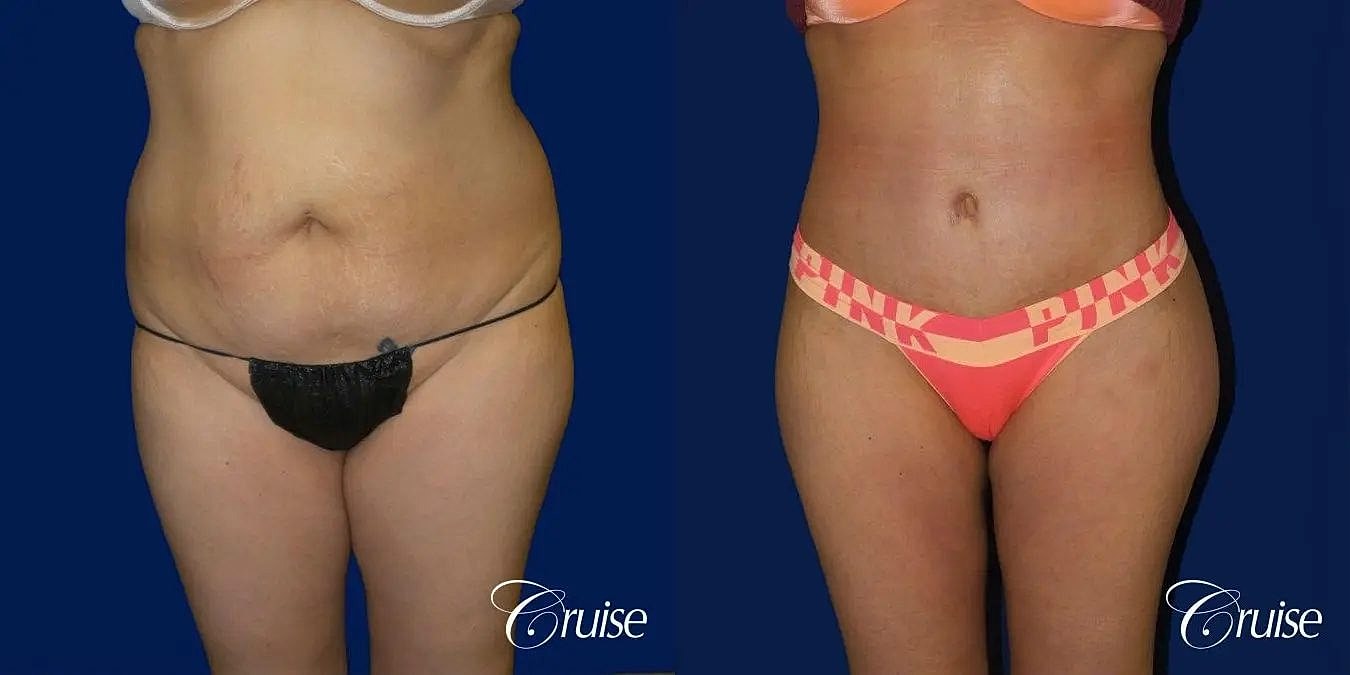 Tummy Tuck Before & After