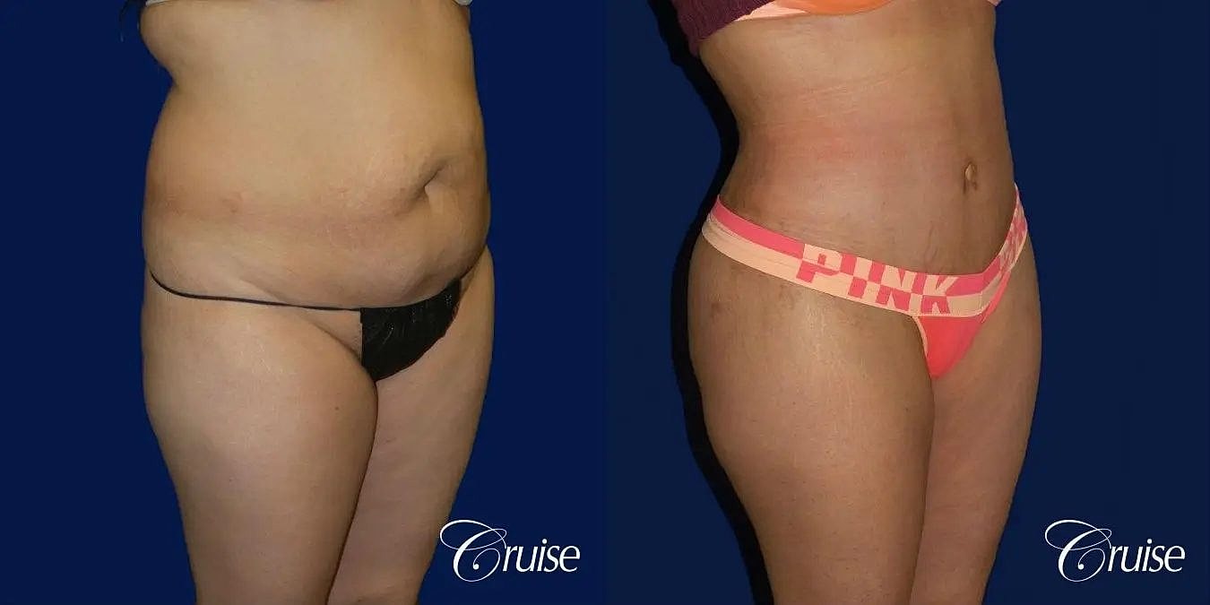 Tummy Tuck Before & After