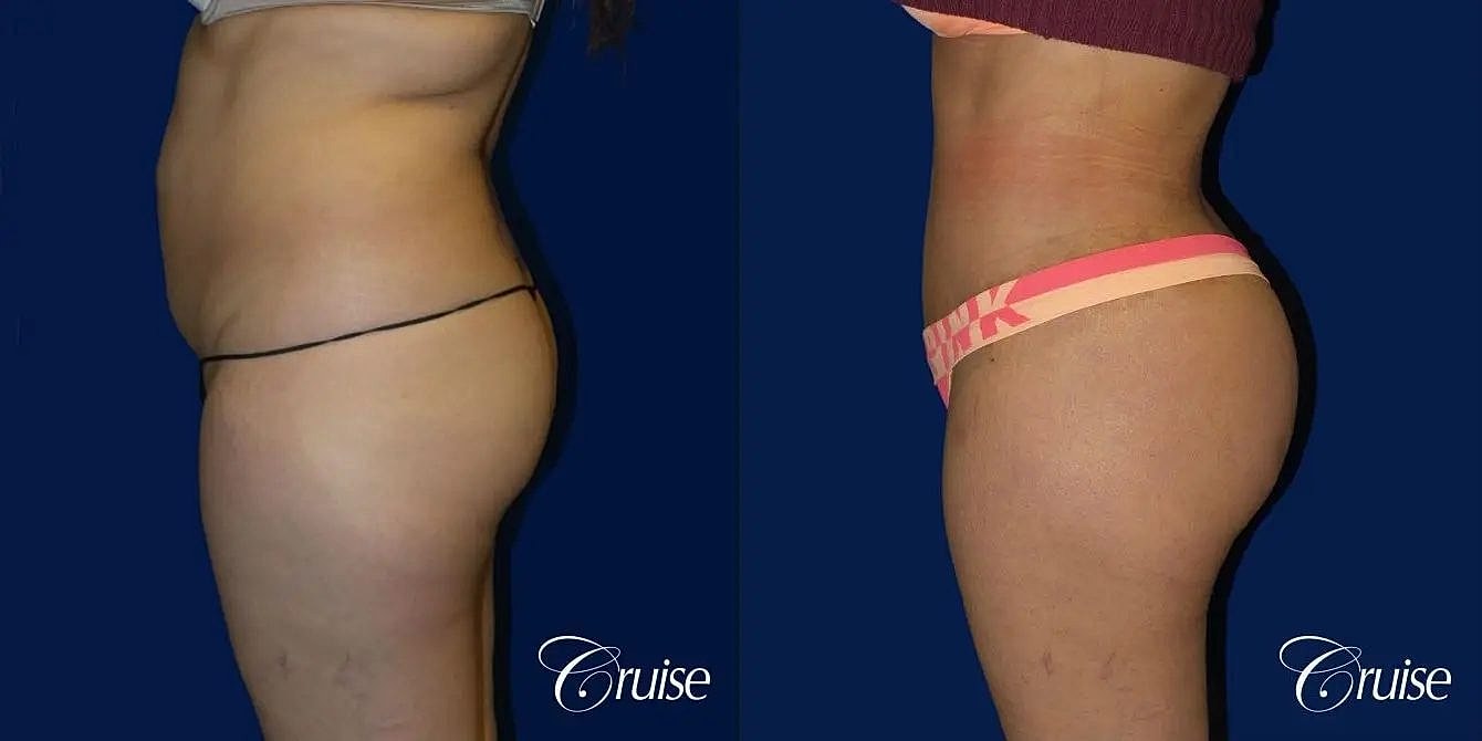 Tummy Tuck Before & After