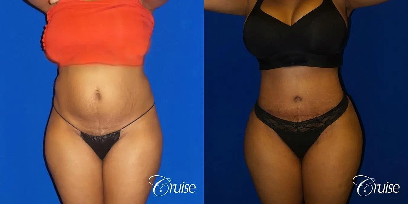 Tummy Tuck Before & After