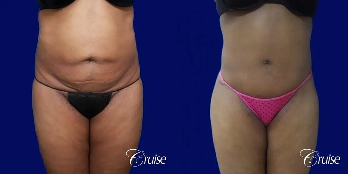 Tummy Tuck Before & After