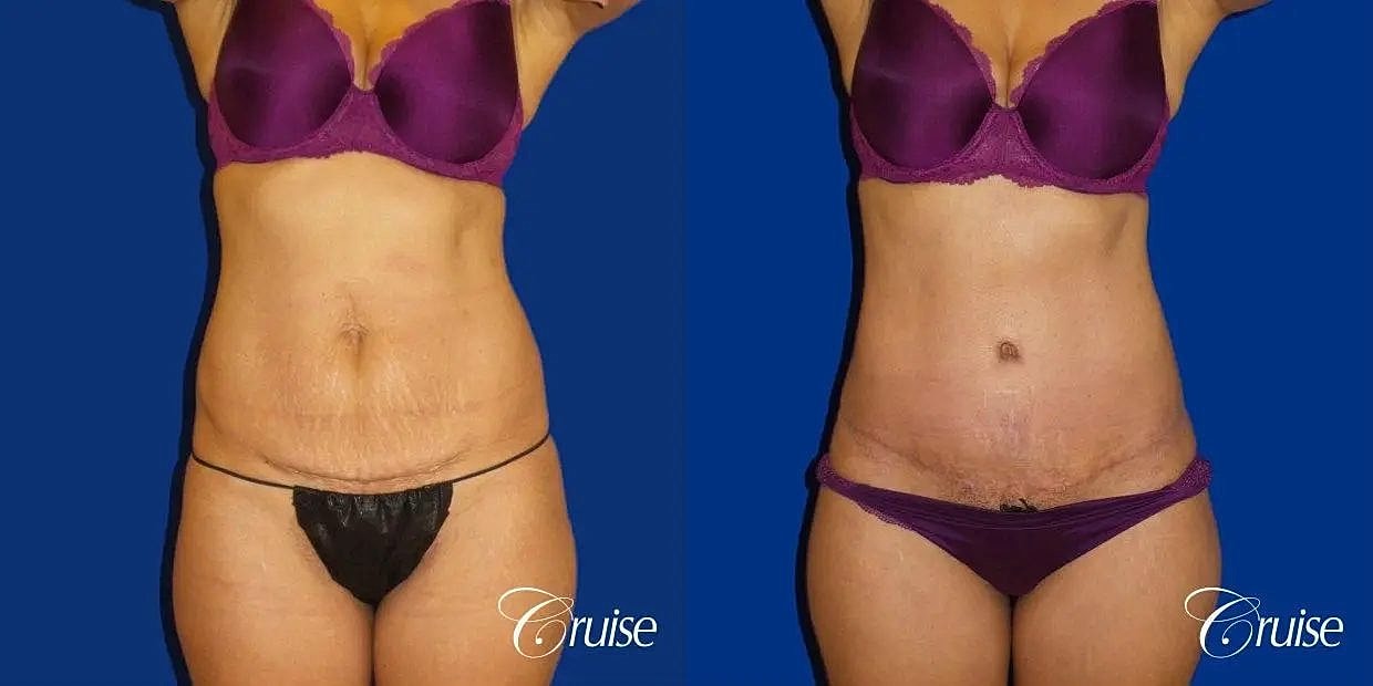 Tummy Tuck Before & After