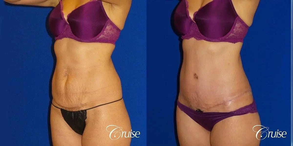 Tummy Tuck Before & After