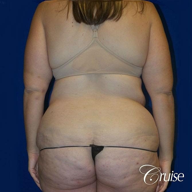 Tummy Tuck Before & After