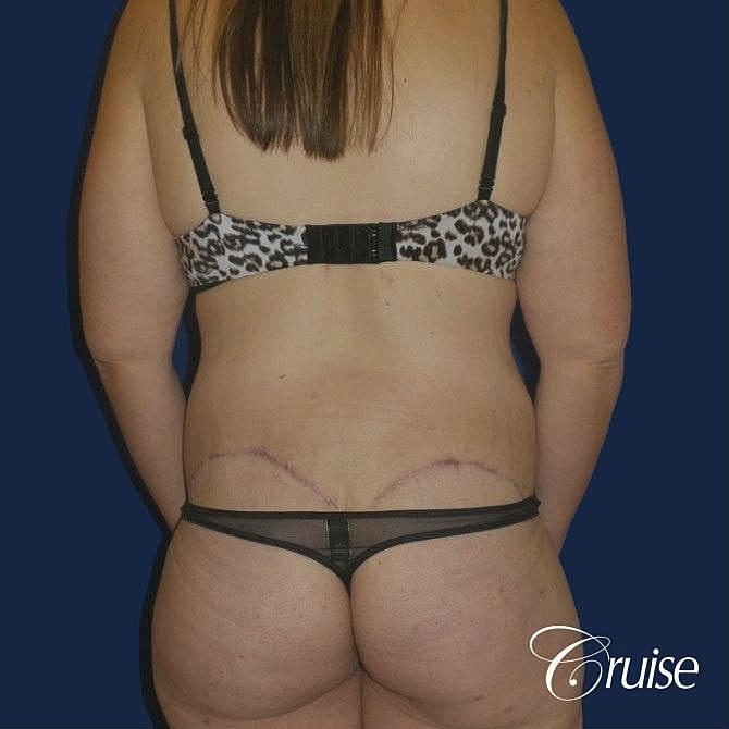 Tummy Tuck Before & After