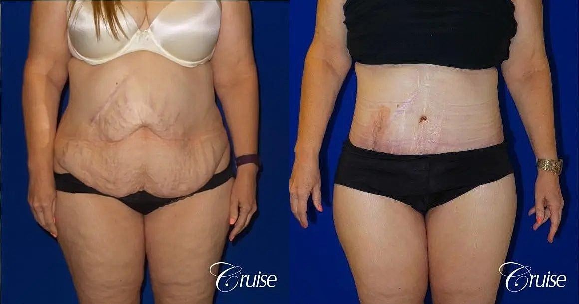 Tummy Tuck Before & After