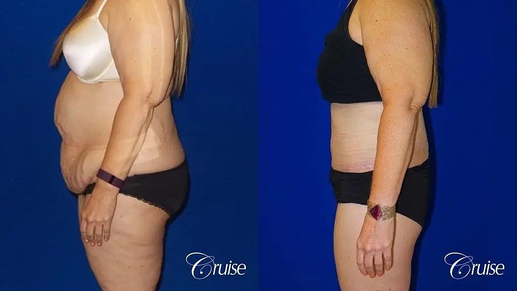 Tummy Tuck Before & After