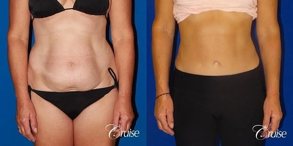 Tummy Tuck Before & After