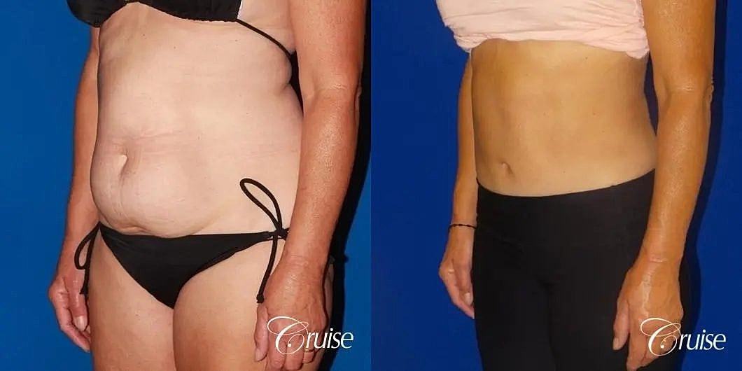 Tummy Tuck Before & After