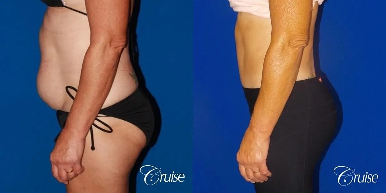 Tummy Tuck Before & After