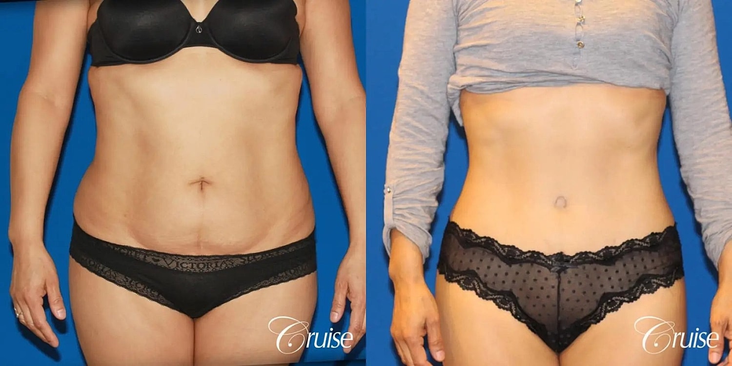 Tummy Tuck Before & After