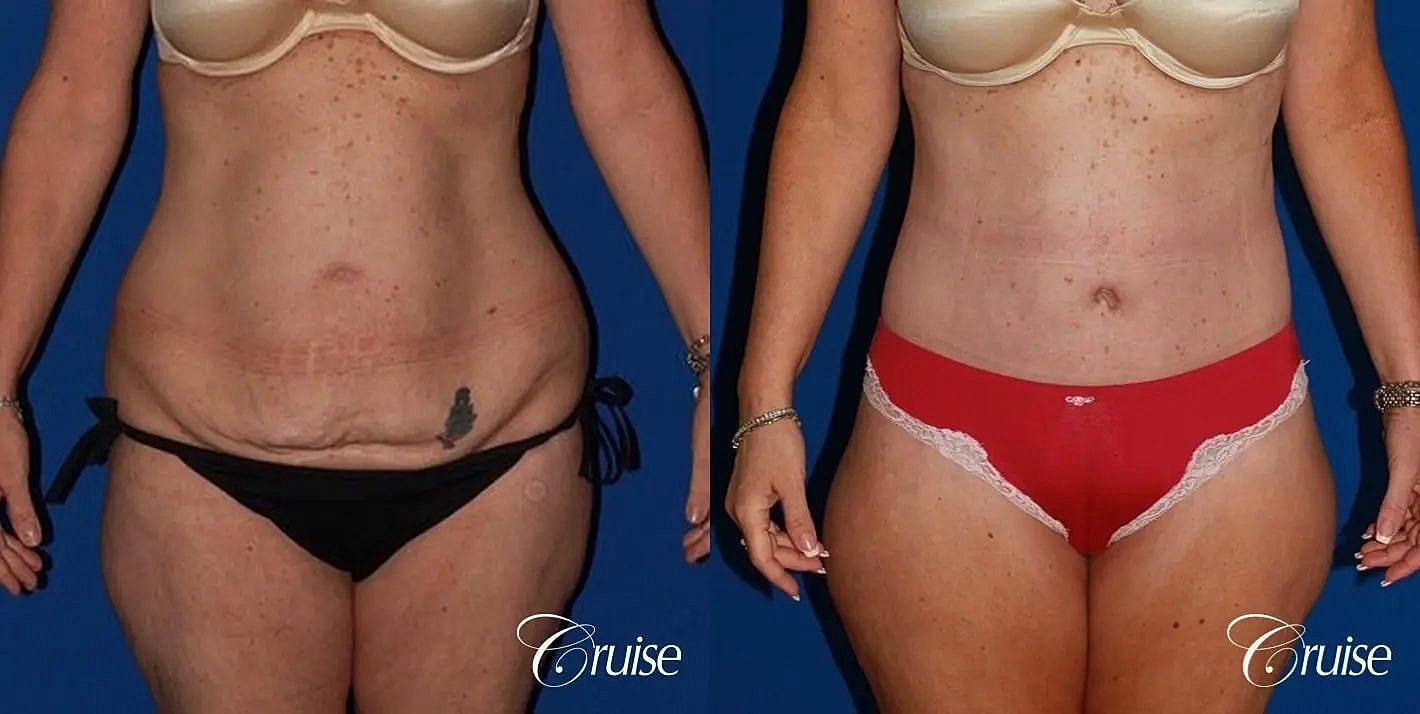 Tummy Tuck Before & After